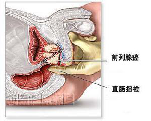 直肠指诊就是医生将戴手套的手指伸入患者直肠,并隔着直肠触摸前列腺