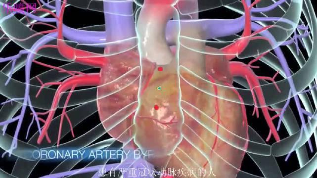 3d动画演示三种心脏搭桥手术,终于看明白了