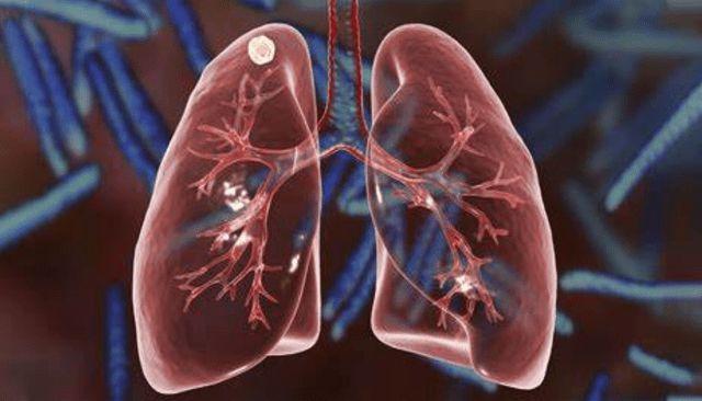 肺部有结节的人这几物不妨多吃点或对肺有益