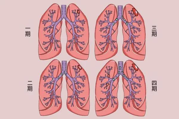 而且,有些人在查出自己的肺部有结节后,就会慌.