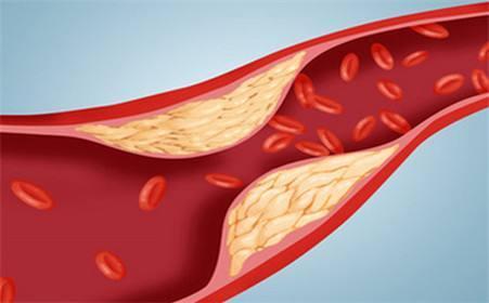 血管硬化可以逆转,经常做1个动作可软化血管,溶血栓!