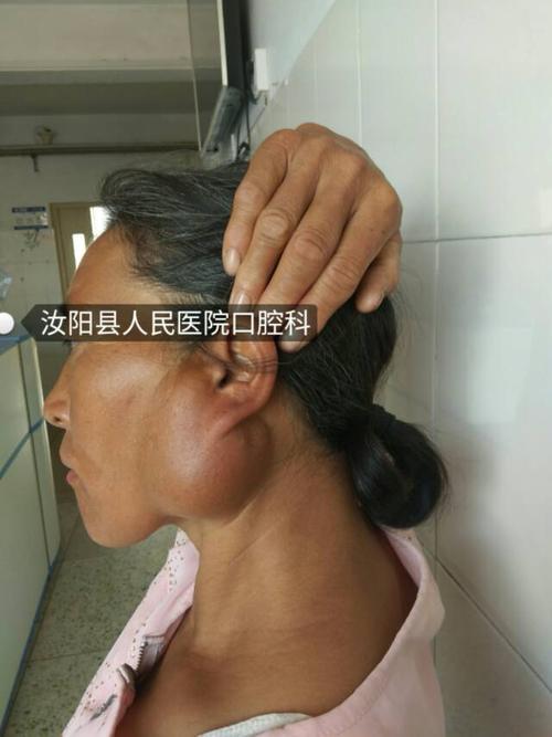 汝阳县人民医院口腔科成功切除腮腺区巨大肿瘤一例