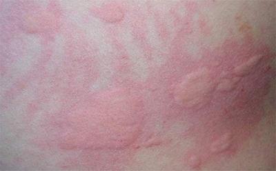 [疾病预防] 过敏性荨麻疹的治疗 如何预防过敏性荨麻疹说到荨麻疹