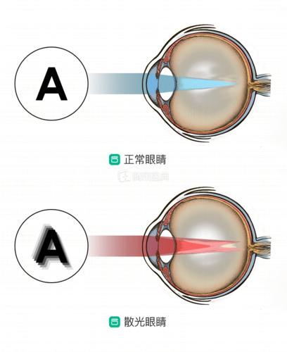 儿童近视性散光怎么治疗医生想要矫正不用手术这5种方法最合适