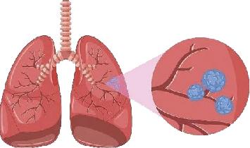 科学防治肺结节 远离肺癌不纠结