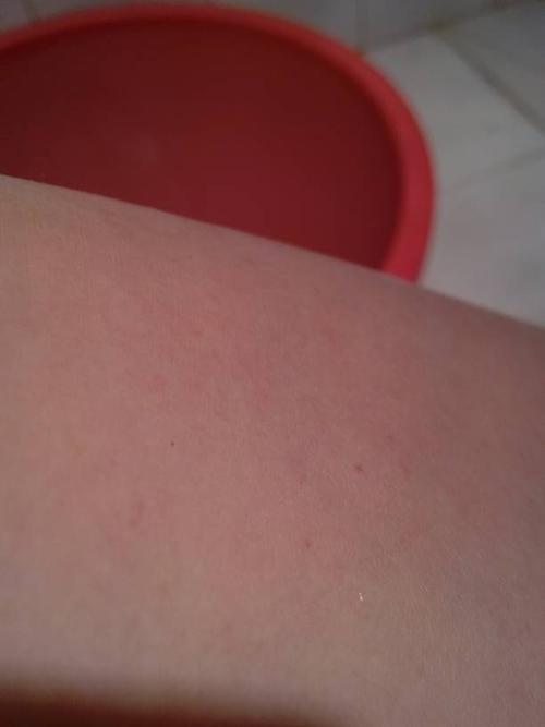 我的腿上长了好多这种红色的小点点?这是什么呀?为什么会长啊?