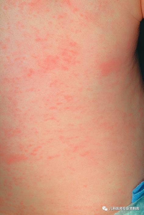 幼儿急疹,风疹,麻疹,猩红热,水痘,荨麻疹,热疹,湿疹等等,皮疹都是什么